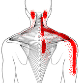 Shoulder Blade Recovery and Why Most Shoulder "Solutions" Don't Work