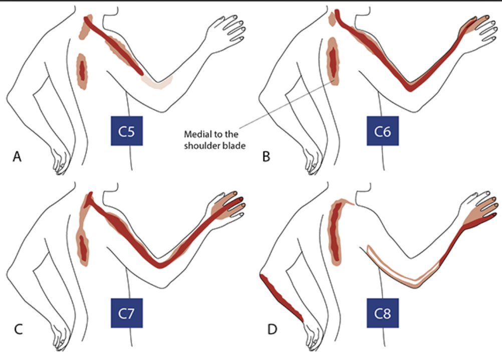 9 Facts About SICK Scapula That May Surprise You