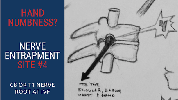 Top 5 Ulnar Nerve Entrapment Locations & Treatments