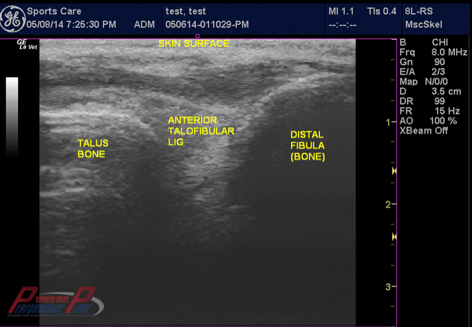 Chronic Ankle Instability MSK Ultrasound Facility
