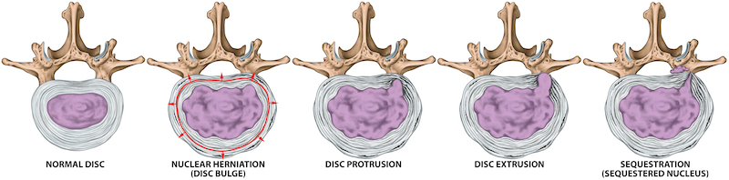 In 20 Minutes, You'll Learn the Truth About Back Pain