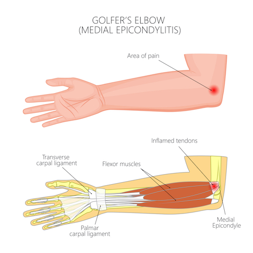 Top 2 Reasons For Elbow Pain While Golfing