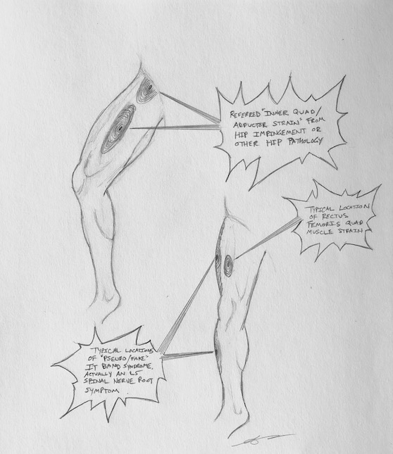 Chronic Hip Flexor Pain When Running Gets 90% Better Within 3 Days