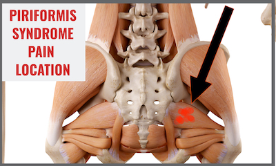 7 Correctable Hip Pain Diagnosis & Treatments for Injured Runners