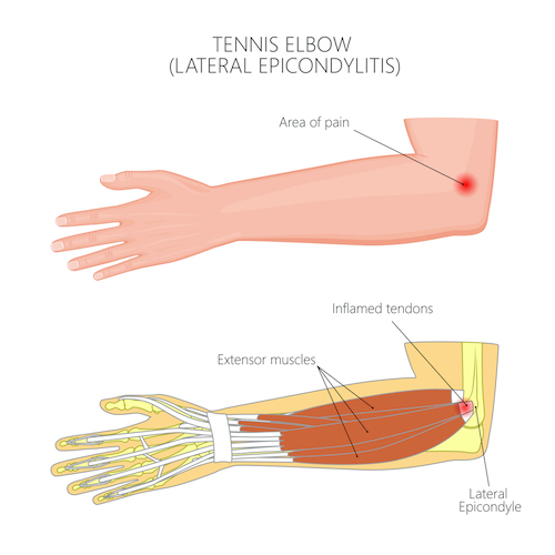 Top 2 Reasons For Elbow Pain While Golfing