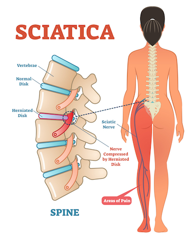 [2022 Update] What Does Sciatica Feel Like (And Other Sciatica Questions)