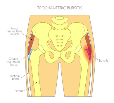 7 Correctable Hip Pain Diagnosis & Treatments for Injured Runners