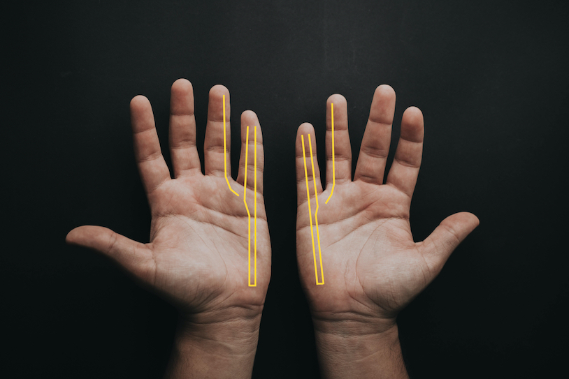 Ulnar Nerve- Syndrome, Exercises & Treatment