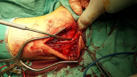 Tennis Elbow (Lateral Epicondylitis): Effective Treatment, Pain Relief [2021]